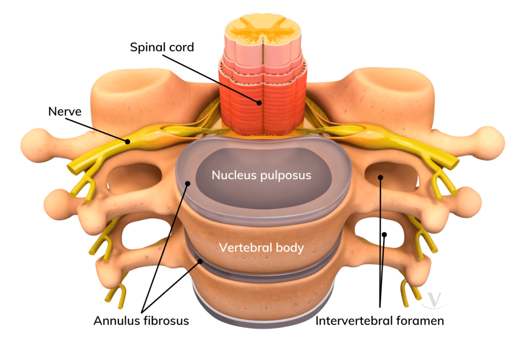 spinal disc image with vertebrae, spinal cord, nerve, annulus fibrosus, nucleus pulposus, and intervertebral foramen labeled.
