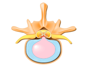 Herniated Disc Example